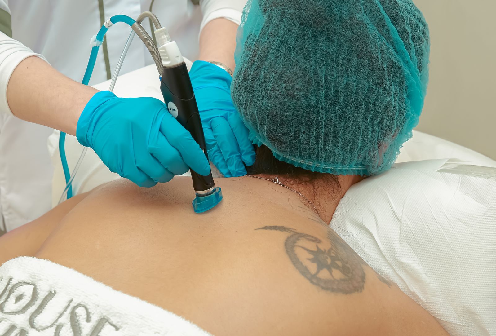 Eliminación de Tatuajes con Láser en Pisco